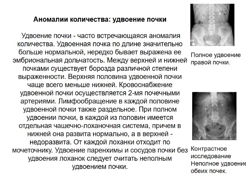 Аномалии количества: удвоение почки     Удвоение почки - часто встречающаяся аномалия